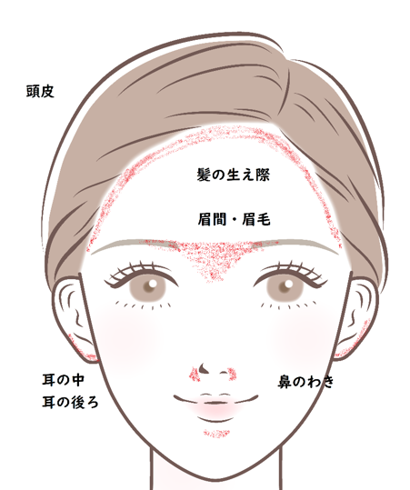 頭皮や顔にできる脂漏性皮膚炎の治し方は 原因や薬についても解説 ひまわり医院 内科 皮膚科