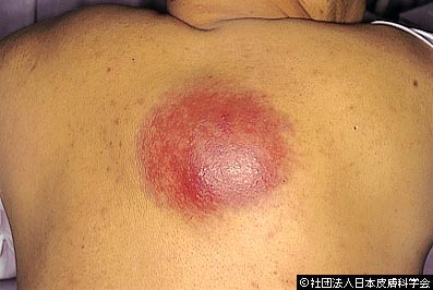 痛い できもの の正体は アテローム 粉瘤 について 原因 治し方 ひまわり医院 内科 皮膚科