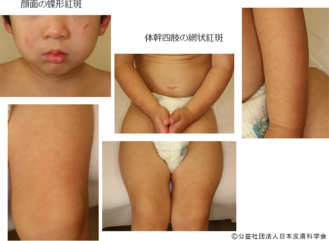 妊婦さんは要注意 リンゴ病 伝染性紅斑 について 症状 発疹 原因 ひまわり医院 内科 皮膚科