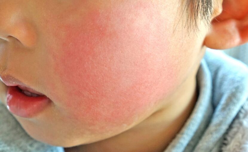 妊婦さんは要注意 リンゴ病 伝染性紅斑 について 症状 発疹 原因 ひまわり医院 内科 皮膚科