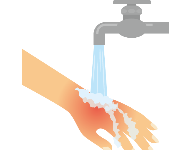 水ぶくれやヒリヒリ痛みも やけど 熱傷 の薬や処置について解説 ひまわり医院 内科 皮膚科