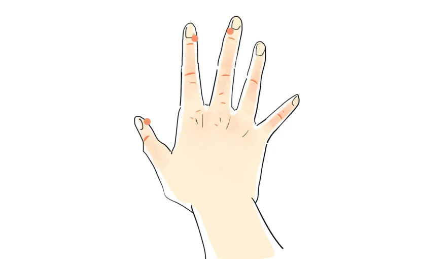 イボといえば液体窒素 イボ 尋常性疣贅 の原因や治療について ひまわり医院 内科 皮膚科 イボといえば液体窒素 イボ 尋常性疣贅 の原因や治療について ひまわり医院 内科 皮膚科